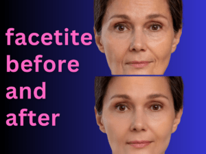 facetite before and after